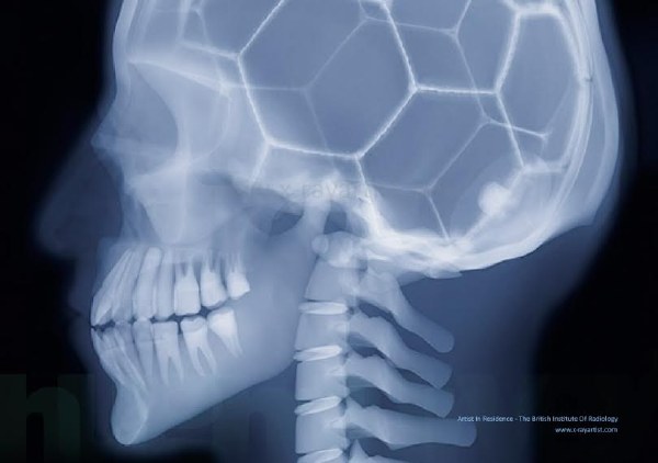 13、我们都见过头骨，而这些六边形却让这个头骨像是个足球。